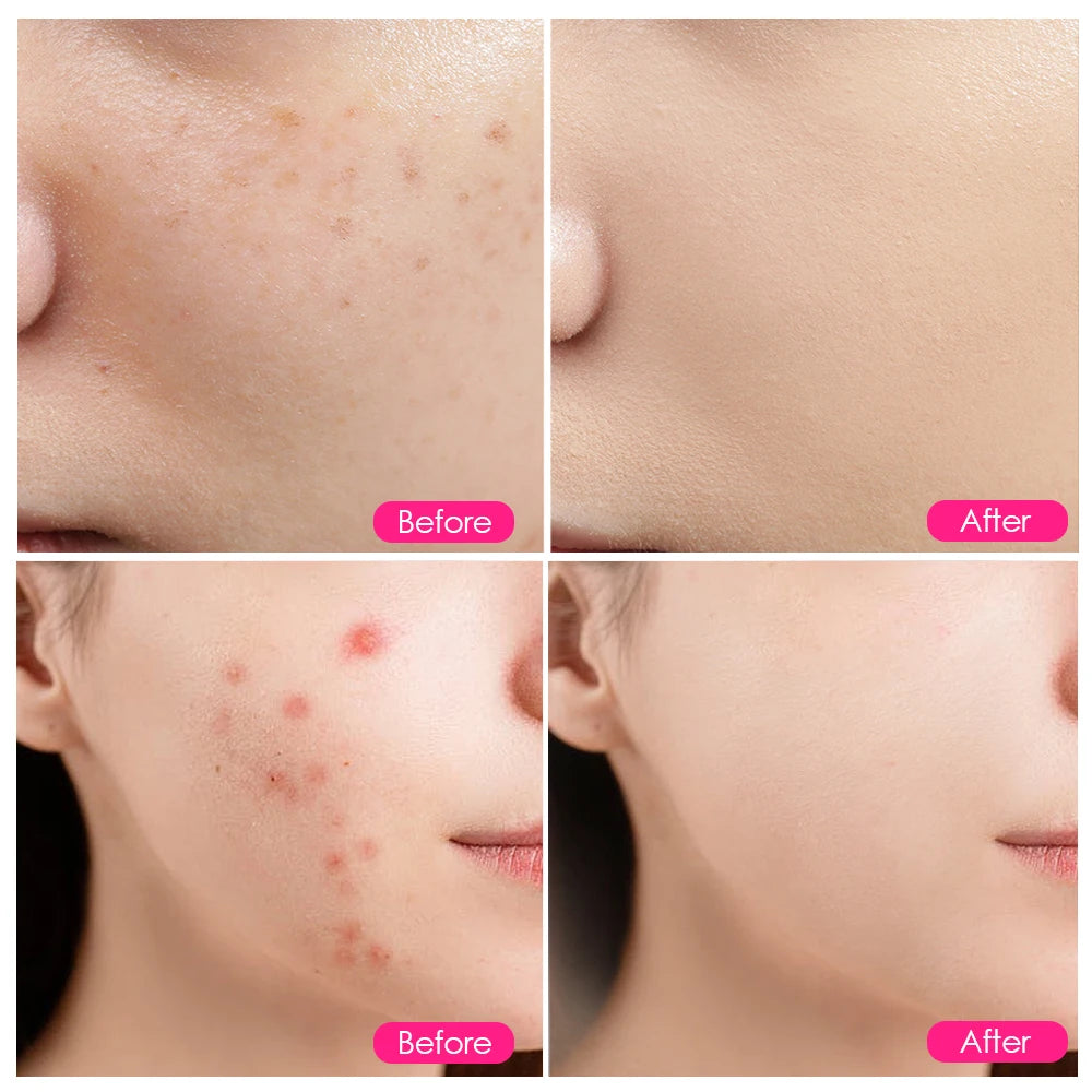 200 LEDs Infrared Light Therapy Lamp Skin Care Anti Aging 660nm 850nm